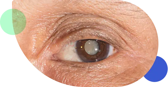 cataracts